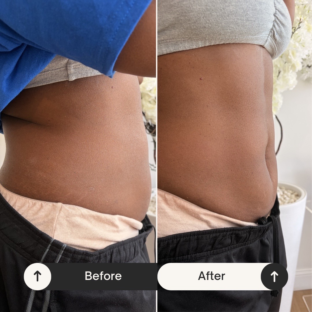 Client before and after a lymphatic drainage session