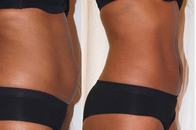 Client waist progress shown in a side-by-side comparison