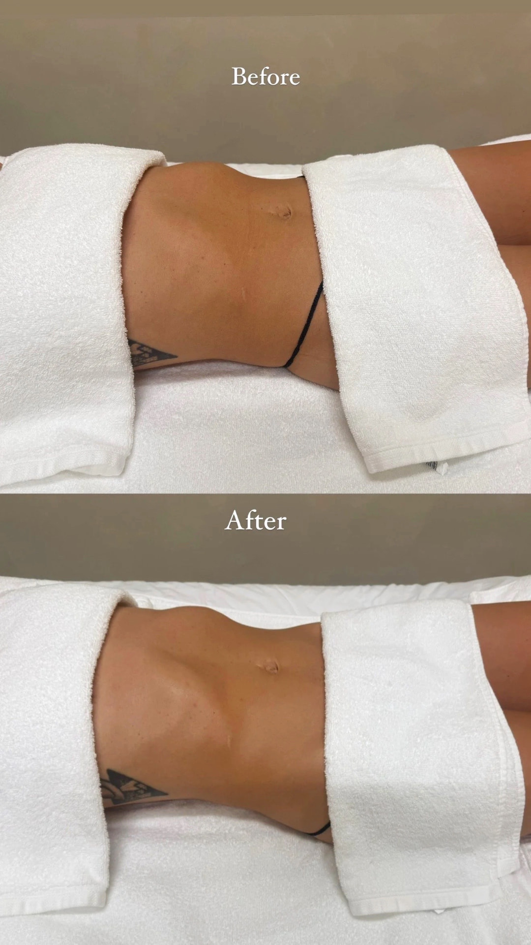 Client before and after a lymphatic drainage session