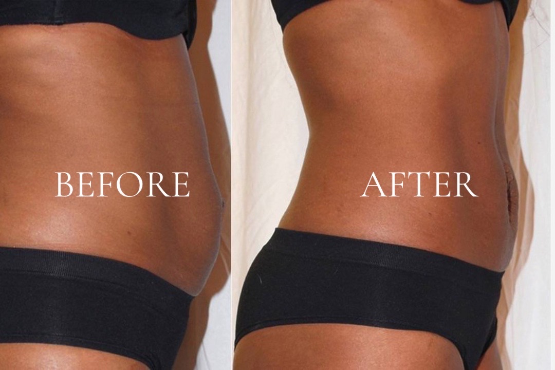 Client before and after a lymphatic drainage session